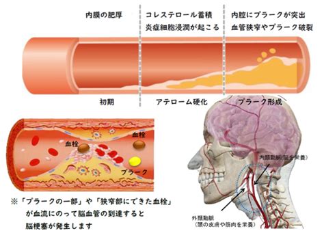 首 脈|内頚動脈狭窄症 ｜ 内頚動脈狭窄症の症状と治療法 ｜ 